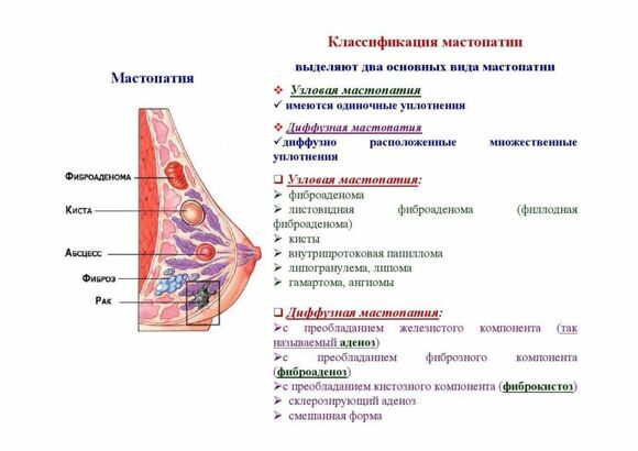 Фиброзно-кистозная мастопатия